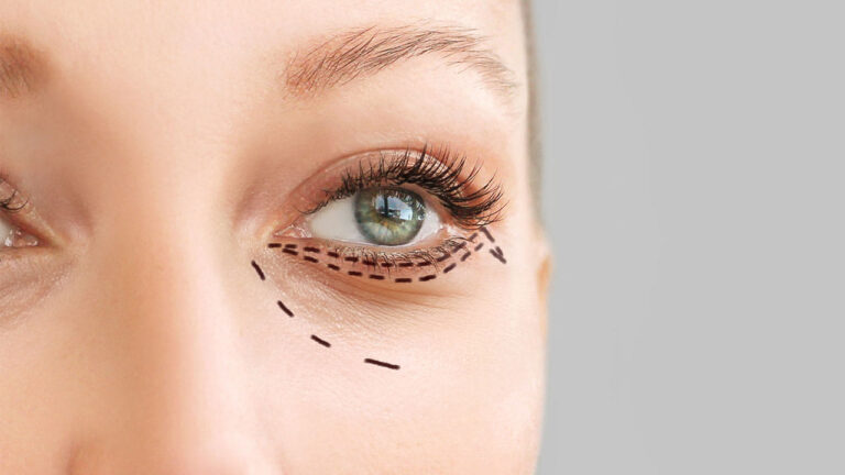 Blefaroplastia